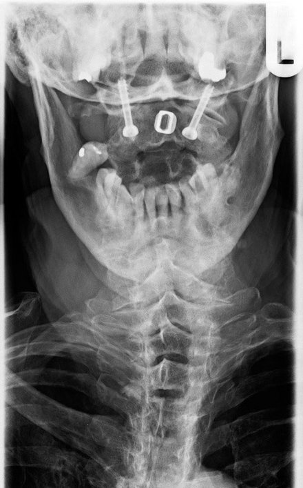 Röntgenaufnahme: Versteifung 1. und 2. Halswirbel bei Rheuma oder Arthrose